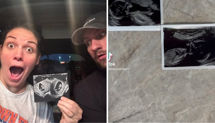 Doctors Left Puzzled After Woman With Two Uteruses Gets Pregnant In Both